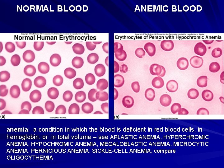 NORMAL BLOOD ANEMIC BLOOD anemia: a condition in which the blood is deficient in