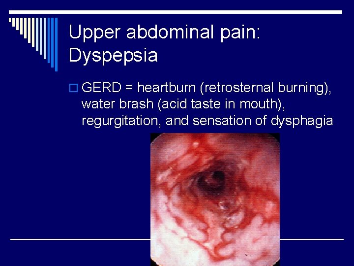 Upper abdominal pain: Dyspepsia o GERD = heartburn (retrosternal burning), water brash (acid taste