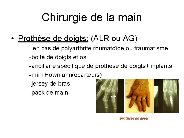 Chirurgie de la main • Prothèse de doigts: (ALR ou AG) en cas de