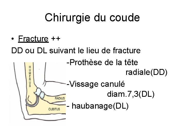 Chirurgie du coude • Fracture ++ DD ou DL suivant le lieu de fracture