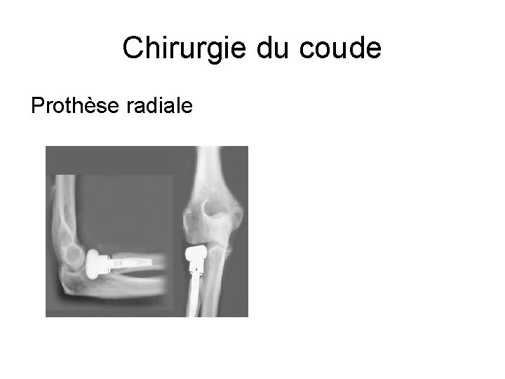 Chirurgie du coude Prothèse radiale 