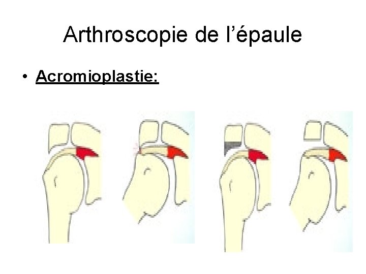 Arthroscopie de l’épaule • Acromioplastie: 
