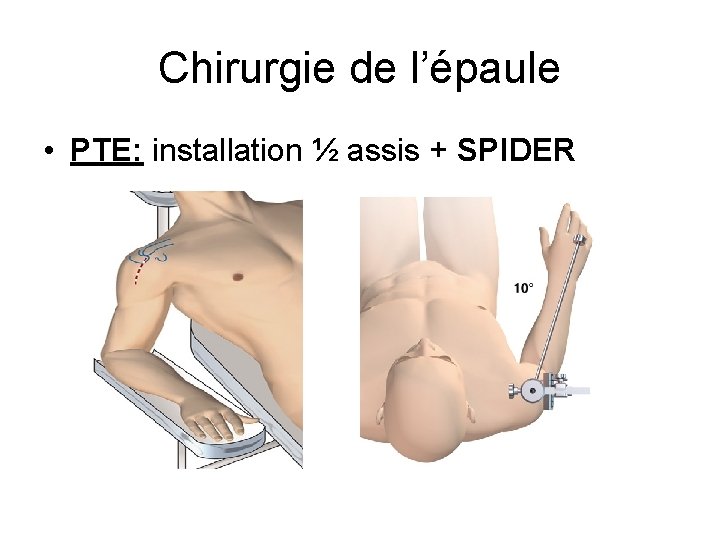 Chirurgie de l’épaule • PTE: installation ½ assis + SPIDER 