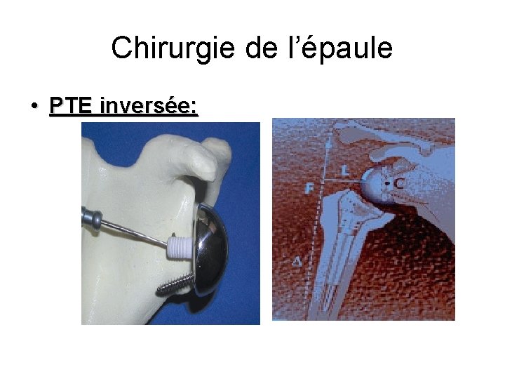 Chirurgie de l’épaule • PTE inversée: 