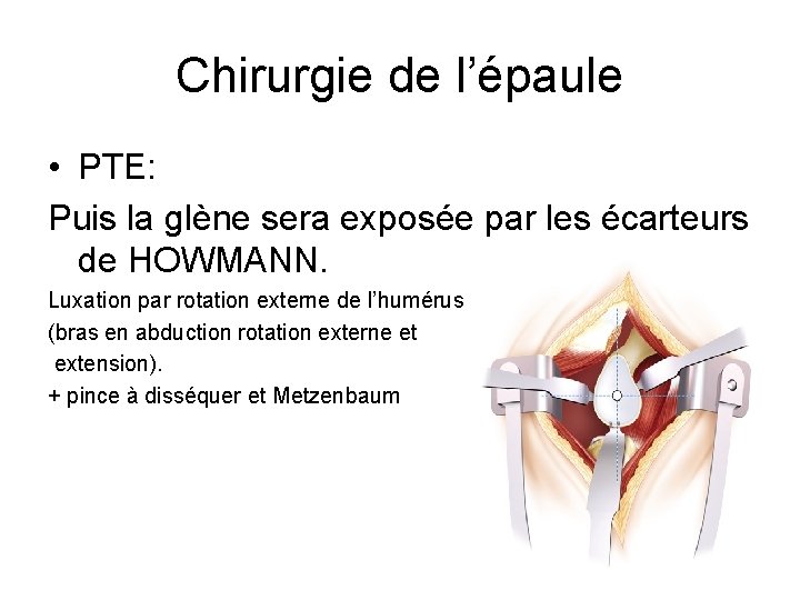 Chirurgie de l’épaule • PTE: Puis la glène sera exposée par les écarteurs de