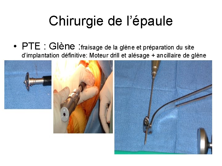 Chirurgie de l’épaule • PTE : Glène : fraisage de la glène et préparation