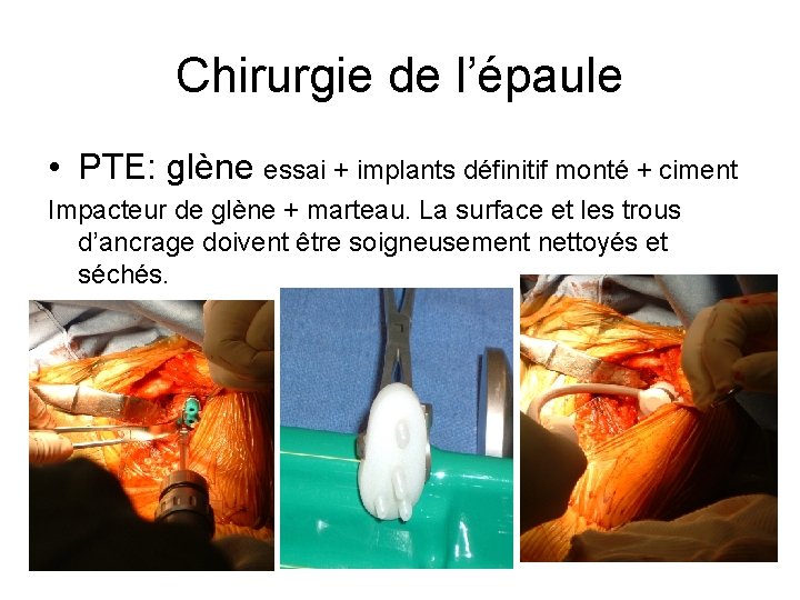 Chirurgie de l’épaule • PTE: glène essai + implants définitif monté + ciment Impacteur