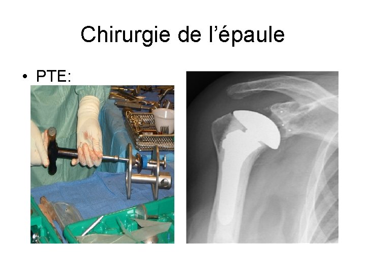 Chirurgie de l’épaule • PTE: 