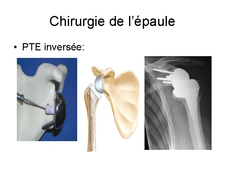Chirurgie de l’épaule • PTE inversée: 