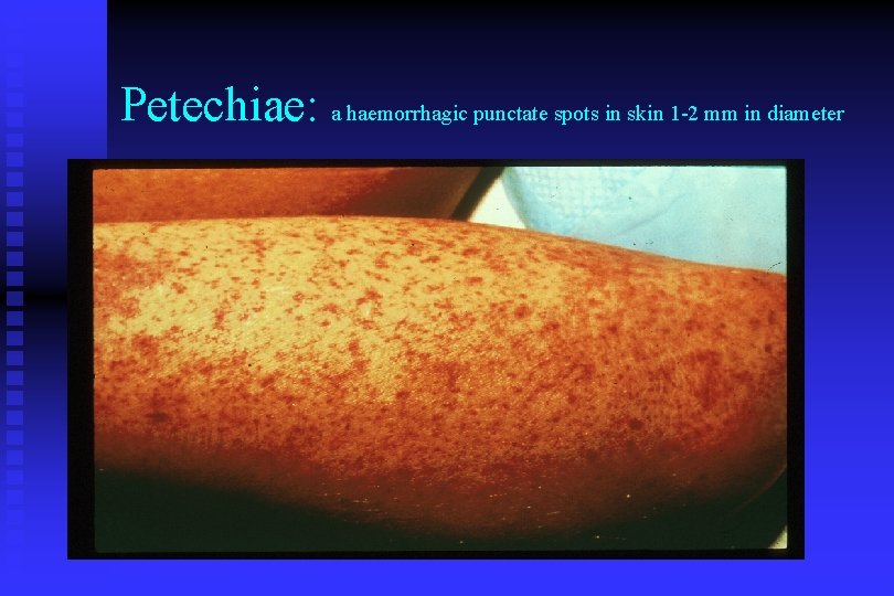Petechiae: a haemorrhagic punctate spots in skin 1 -2 mm in diameter 