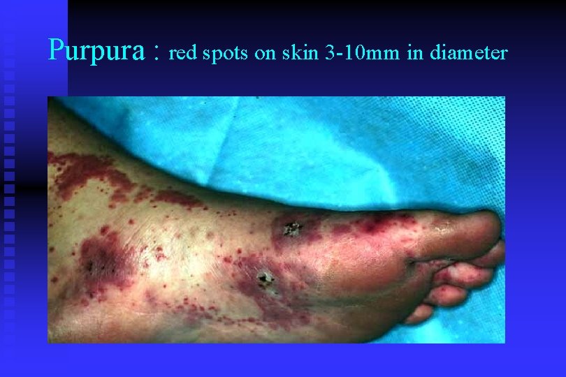 Purpura : red spots on skin 3 -10 mm in diameter 