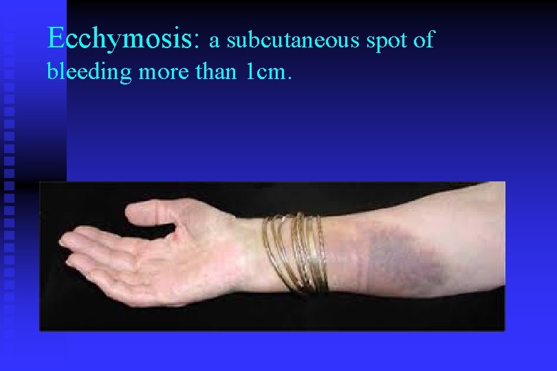 Ecchymosis: a subcutaneous spot of bleeding more than 1 cm. 