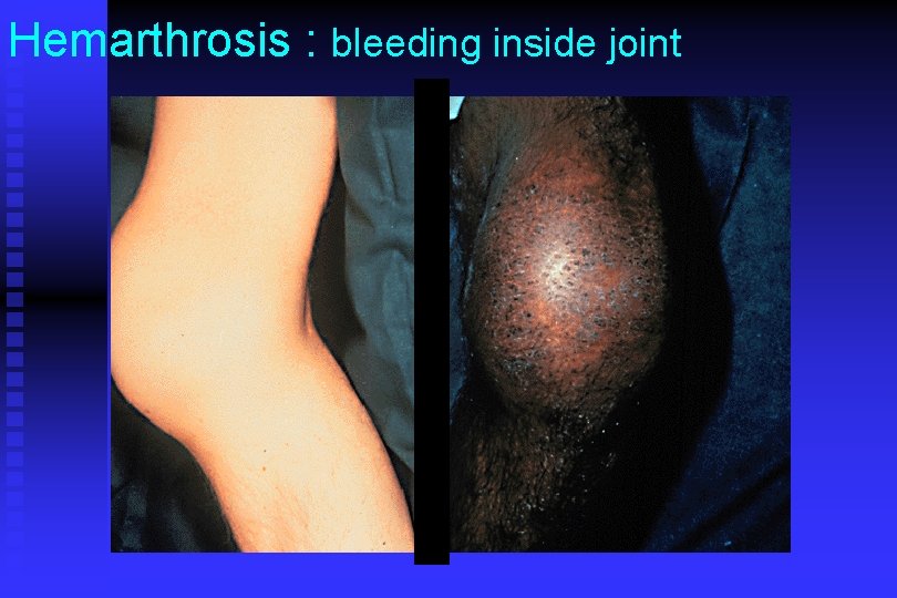 Hemarthrosis : bleeding inside joint 