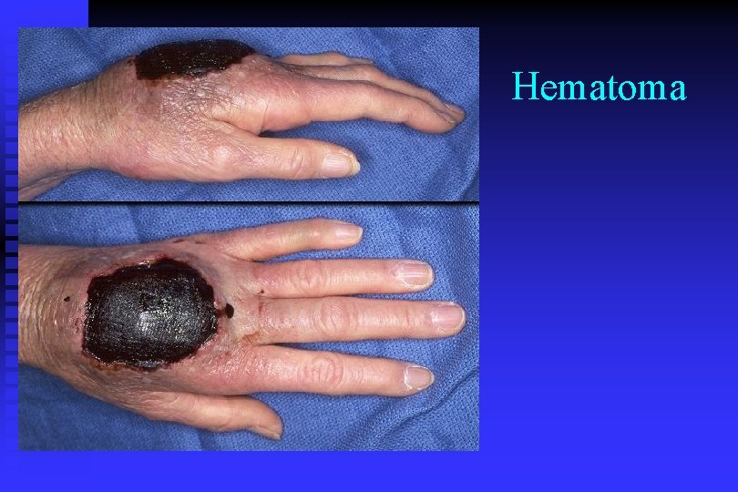 Hematoma 