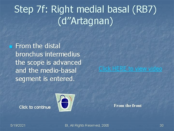 Step 7 f: Right medial basal (RB 7) (d”Artagnan) n From the distal bronchus