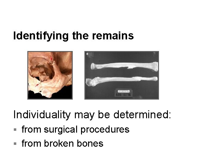 Identifying the remains Individuality may be determined: from surgical procedures § from broken bones Identifying the remains Individuality may be determined: from surgical procedures § from broken bones