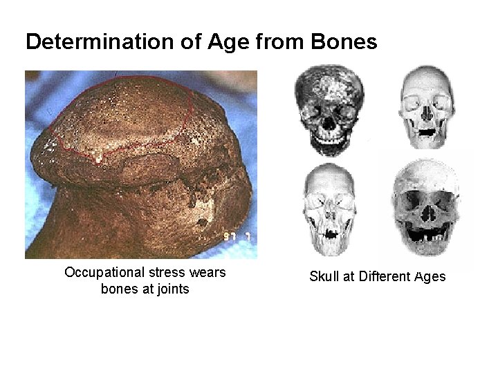 Determination of Age from Bones Occupational stress wears bones at joints Skull at Different Determination of Age from Bones Occupational stress wears bones at joints Skull at Different