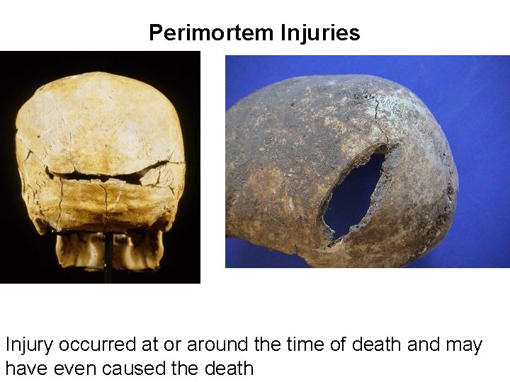 Perimortem Injuries Injury occurred at or around the time of death and may have Perimortem Injuries Injury occurred at or around the time of death and may have