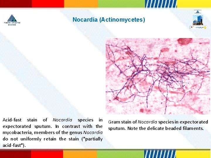 Nocardia (Actinomycetes) Acid-fast stain of Nocardia species in expectorated sputum. In contrast with the