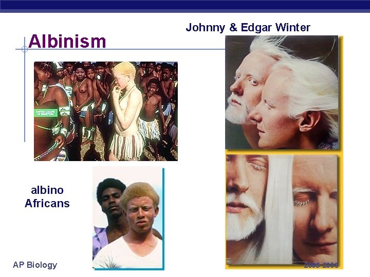 Albinism Johnny & Edgar Winter albino Africans AP Biology 2005 -2006 