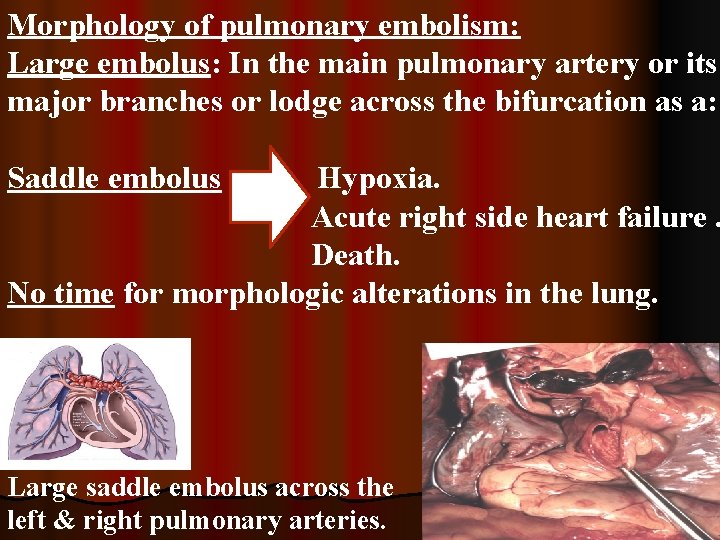 Morphology of pulmonary embolism: Large embolus: In the main pulmonary artery or its major