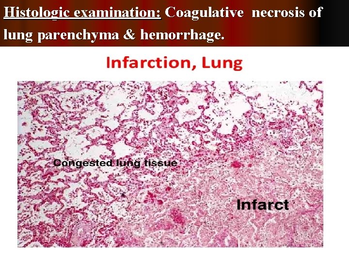Histologic examination: Coagulative necrosis of lung parenchyma & hemorrhage. 