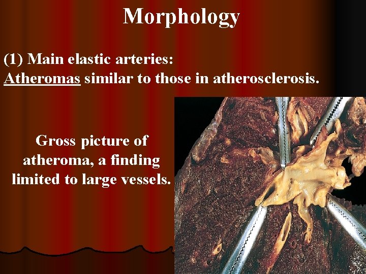 Morphology (1) Main elastic arteries: Atheromas similar to those in atherosclerosis. Gross picture of