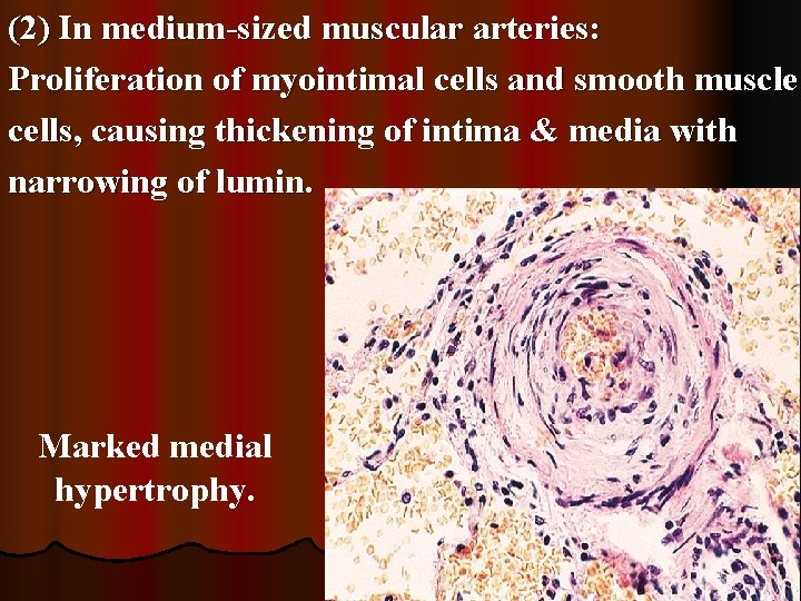 (2) In medium-sized muscular arteries: Proliferation of myointimal cells and smooth muscle cells, causing