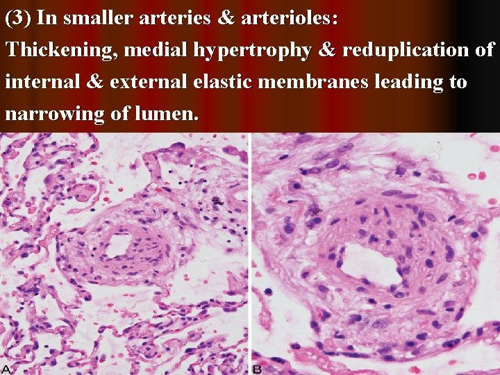 (3) In smaller arteries & arterioles: Thickening, medial hypertrophy & reduplication of internal &