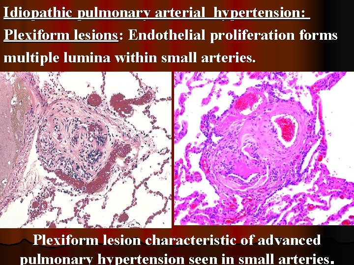 Idiopathic pulmonary arterial hypertension: Plexiform lesions: Endothelial proliferation forms multiple lumina within small arteries.