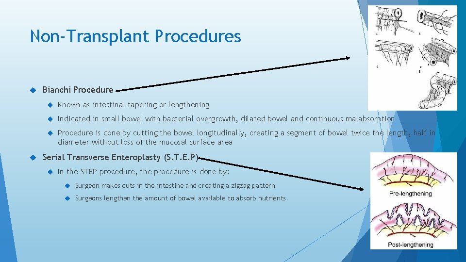 Non-Transplant Procedures Bianchi Procedure Known as intestinal tapering or lengthening Indicated in small bowel