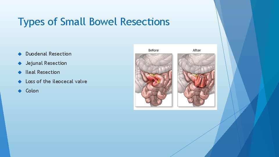 Types of Small Bowel Resections Duodenal Resection Jejunal Resection Ileal Resection Loss of the