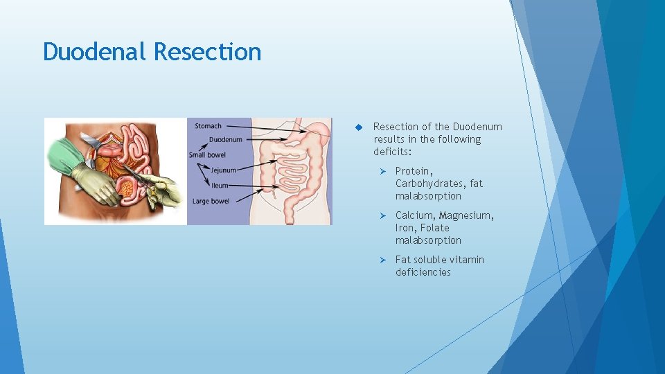 Duodenal Resection of the Duodenum results in the following deficits: Ø Protein, Carbohydrates, fat