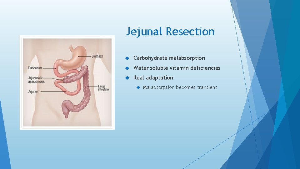 Jejunal Resection Carbohydrate malabsorption Water soluble vitamin deficiencies Ileal adaptation Malabsorption becomes transient 