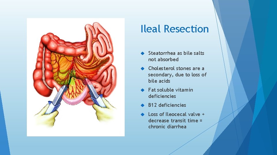Ileal Resection Steatorrhea as bile salts not absorbed Cholesterol stones are a secondary, due