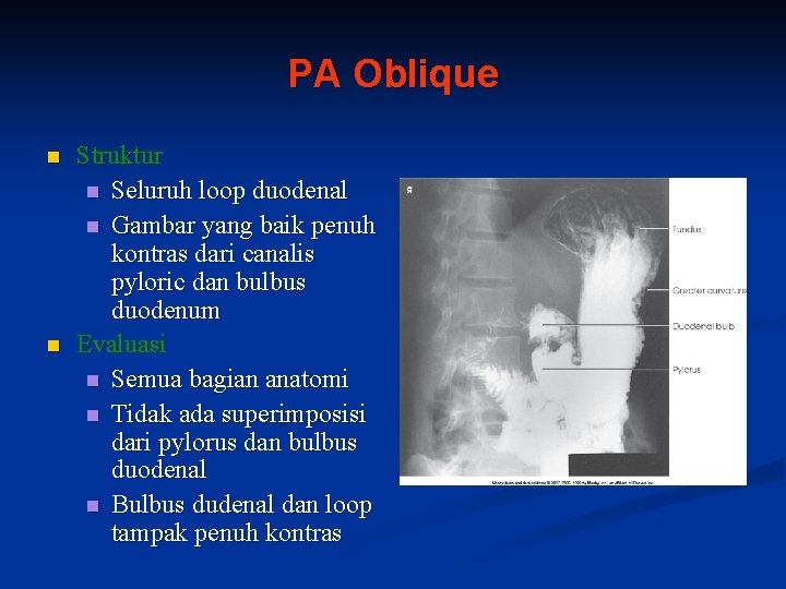 PA Oblique n n Struktur n Seluruh loop duodenal n Gambar yang baik penuh