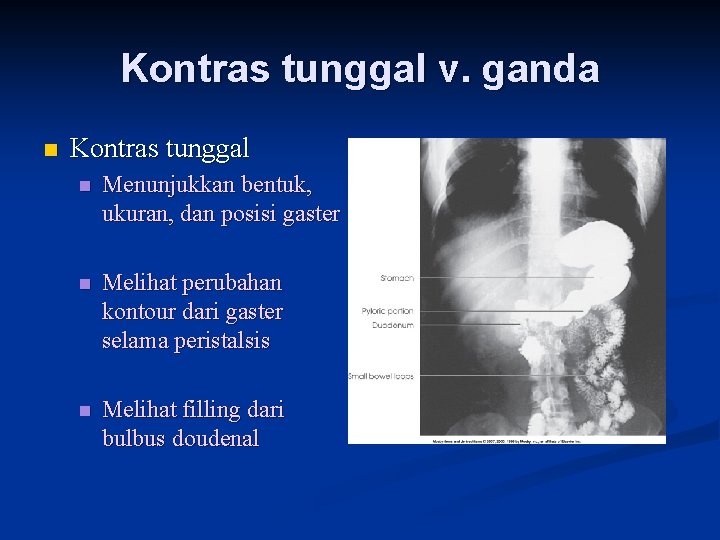 Kontras tunggal v. ganda n Kontras tunggal n Menunjukkan bentuk, ukuran, dan posisi gaster