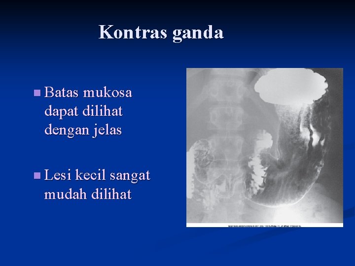Kontras ganda n Batas mukosa dapat dilihat dengan jelas n Lesi kecil sangat mudah