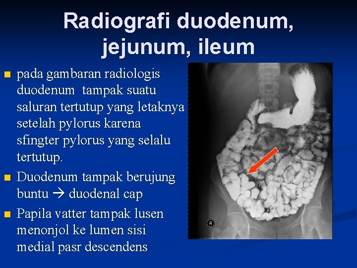 Radiografi duodenum, jejunum, ileum n n n pada gambaran radiologis duodenum tampak suatu saluran