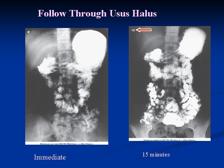 Follow Through Usus Halus Immediate 15 minutes 
