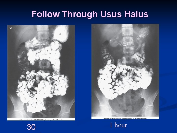 Follow Through Usus Halus 30 1 hour 