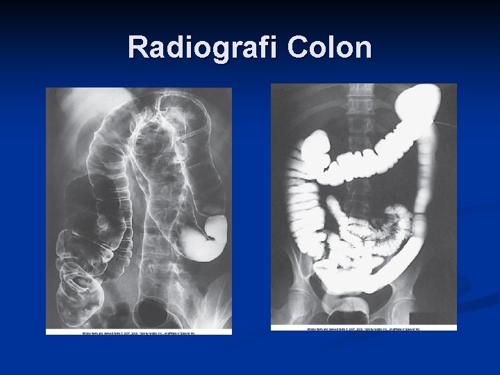Radiografi Colon 