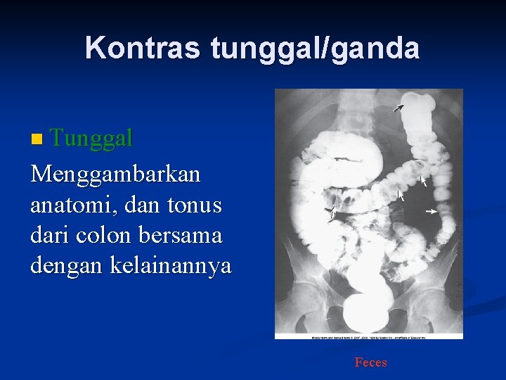 Kontras tunggal/ganda n Tunggal Menggambarkan anatomi, dan tonus dari colon bersama dengan kelainannya Feces