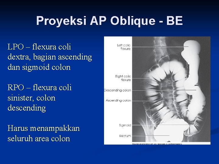 Proyeksi AP Oblique - BE LPO – flexura coli dextra, bagian ascending dan sigmoid