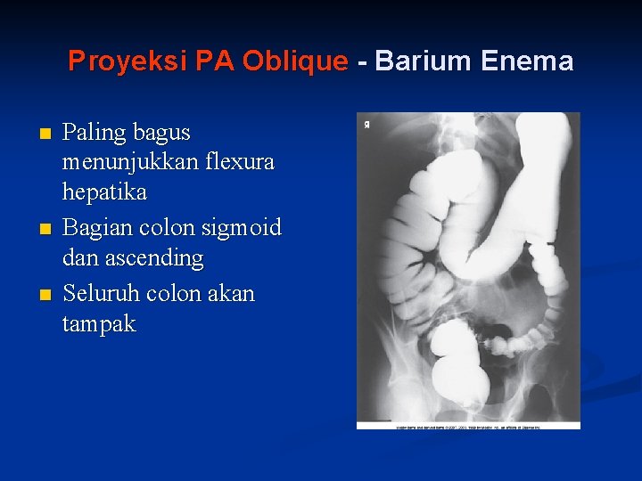 Proyeksi PA Oblique - Barium Enema n n n Paling bagus menunjukkan flexura hepatika