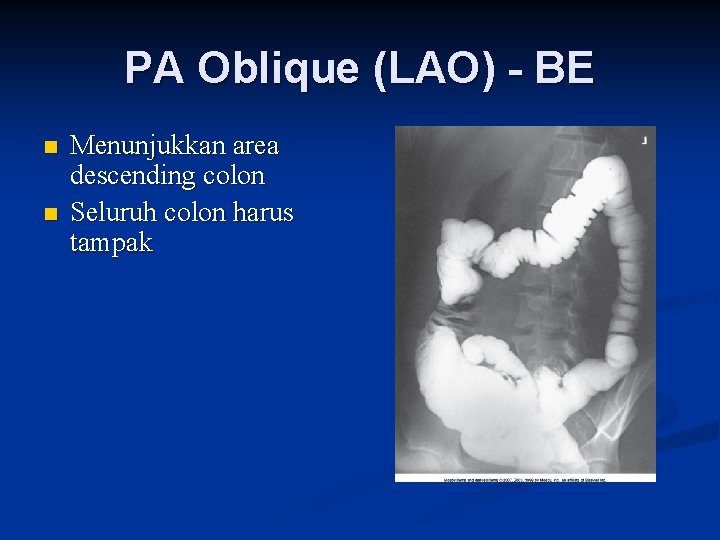 PA Oblique (LAO) - BE n n Menunjukkan area descending colon Seluruh colon harus