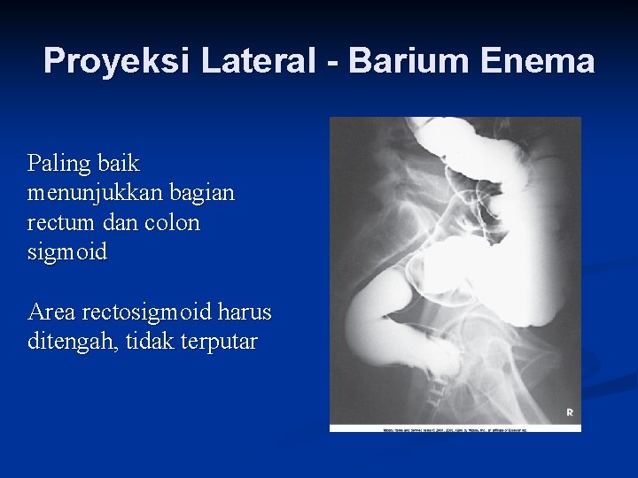 Proyeksi Lateral - Barium Enema Paling baik menunjukkan bagian rectum dan colon sigmoid Area