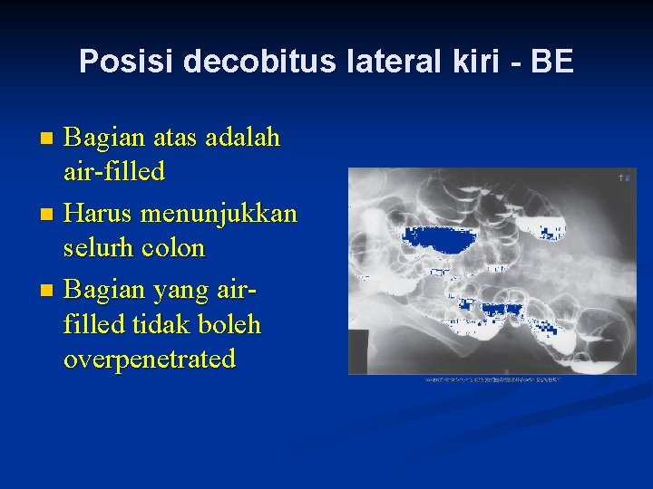 Posisi decobitus lateral kiri - BE Bagian atas adalah air-filled n Harus menunjukkan selurh