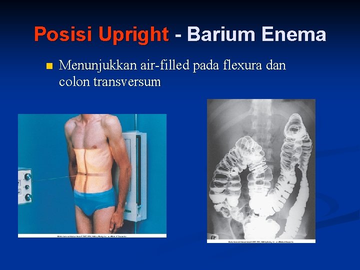 Posisi Upright - Barium Enema n Menunjukkan air-filled pada flexura dan colon transversum 