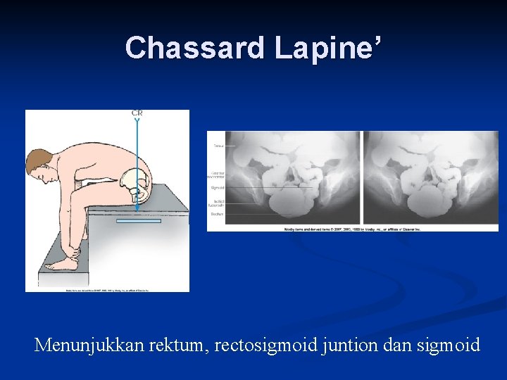 Chassard Lapine’ Menunjukkan rektum, rectosigmoid juntion dan sigmoid 